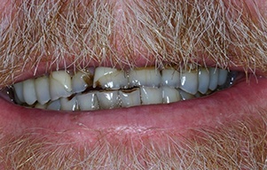 Closeup of severely decayed and discolored teeth