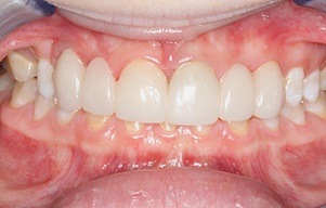 Closeup of bright white smile with no more staining