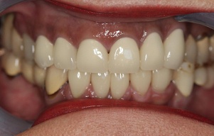 Beautiful smile after damaged teeth were repaired