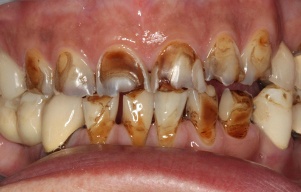 Teeth that are seriously decayed and cracked