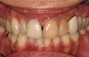 Closeup of teeth with severely discolored right front teeth