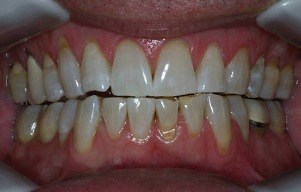 Closeup of white smile following treatment