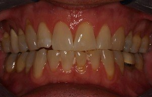 Closeup of severely yellowed teeth