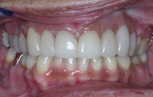 Closeup of smile that is consistently bright white