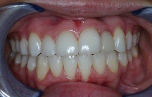 Closeup of smile with flawless tooth replacement
