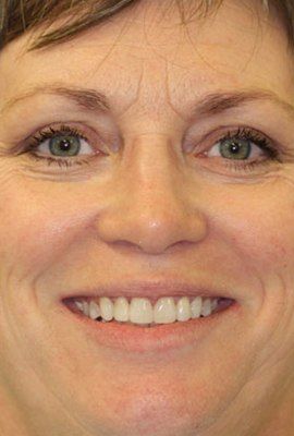 Patient with a flawlessly repaired, gap-free smile