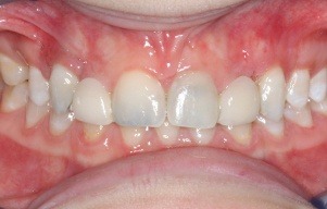 Closeup of teeth with blue-tinged stains