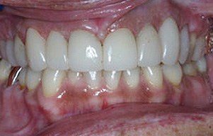 Closeup of smile after flawless restoration