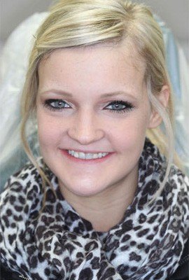 Young woman with dark staining on her top teeth