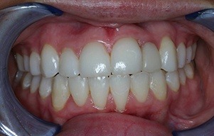 Closeup of natural looking replacement tooth