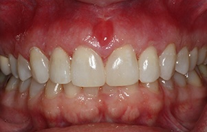 Closeup of smile after gap between teeth was closed