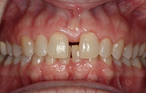 Closeup of teeth with large gap
