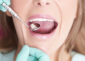 Smile examined after metal-free restorations