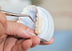 Model of smile with fixed bridge