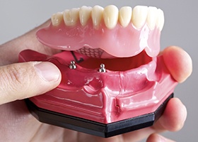 Model of implant retained denture