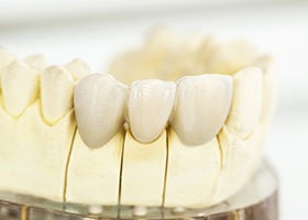 Model of dental bridge restoration