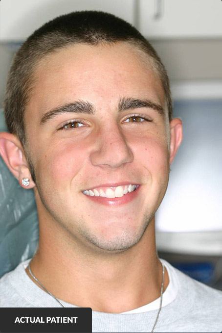 Young man with perfectly straightened teeth